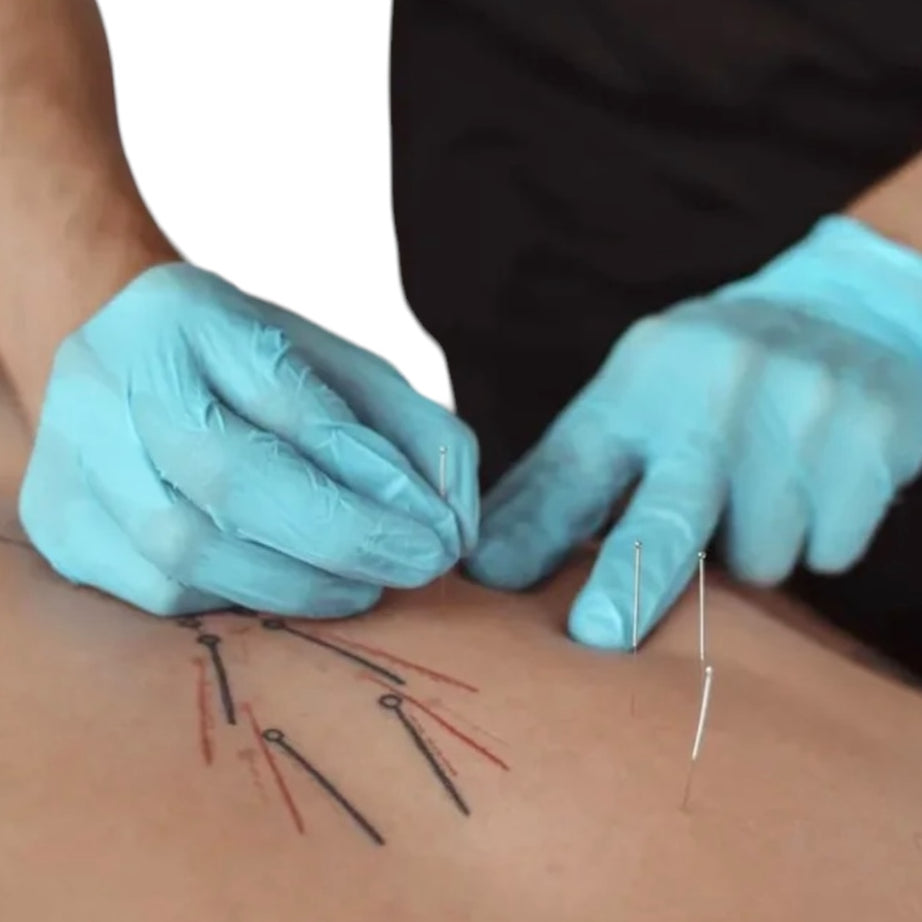 AGUJA ACUPUNTURA 500 UNIDADES