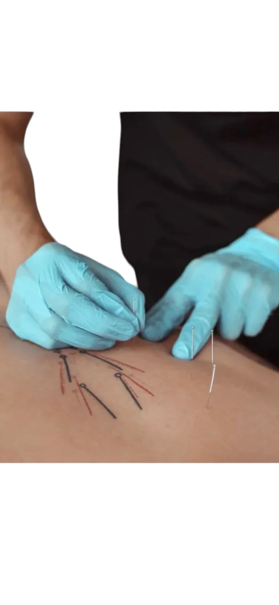 AGUJA ACUPUNTURA 500 UNIDADES